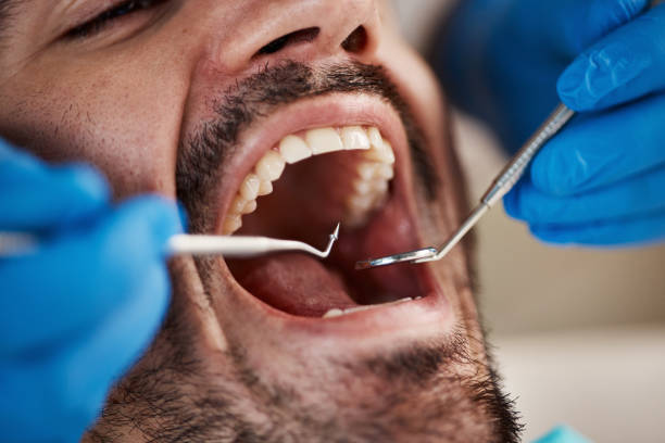 Best Emergency Broken Tooth Repair in Mamou, LA